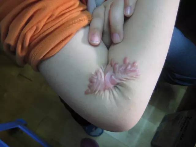 最新缝针疤痕背后的感人故事揭秘