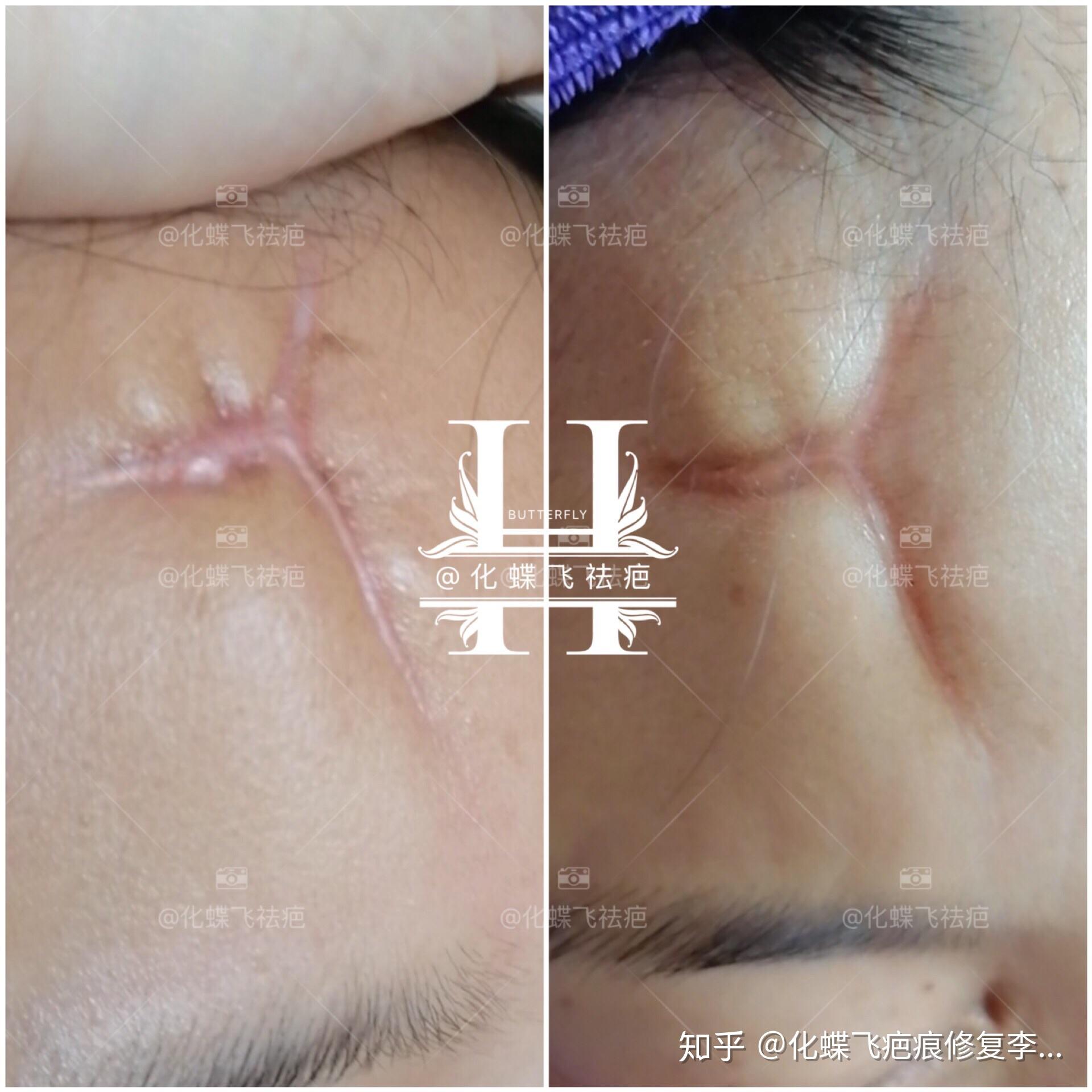 最新缝针疤痕背后的感人故事揭秘