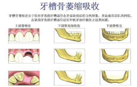 最新种牙费用揭秘,小巷中的隐秘宝藏,种牙费用大公开