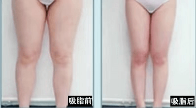 最新减肥吸脂技术，重塑自信身材的捷径之路