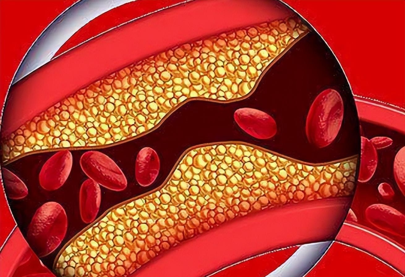 颈动脉斑块最新特效药揭秘，小巷深处的健康秘密探索