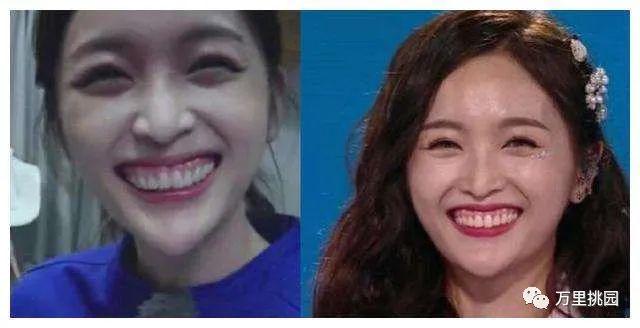 明星全口假牙安装指南,从初学者到进阶用户的安装步骤详解