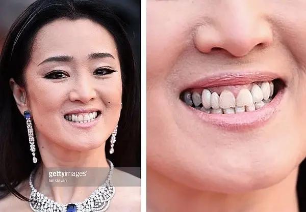 明星全口假牙安装指南,从初学者到进阶用户的安装步骤详解