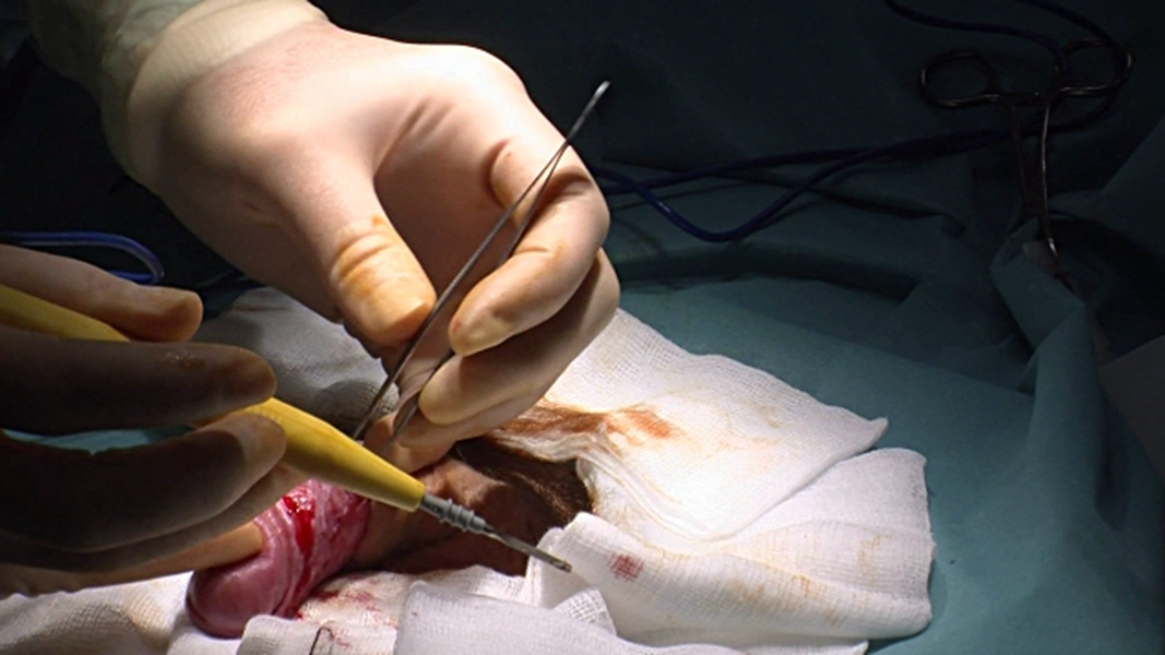 最新包皮手术,蜕变之旅,自信与成长的启程