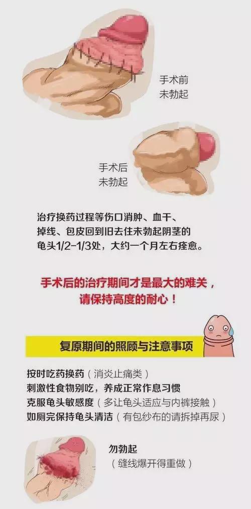 最新包皮手术,蜕变之旅,自信与成长的启程