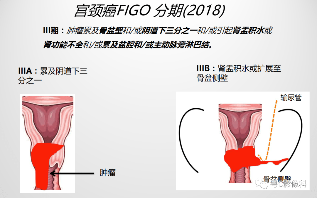 压疮分期与临床表现最新解读