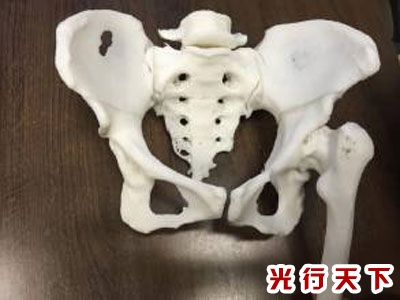 3D打印髋关节最新进展论述，技术革新与应用前景