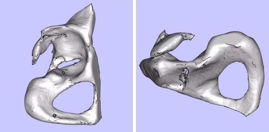 3D打印髋关节最新进展论述,技术革新与应用前景