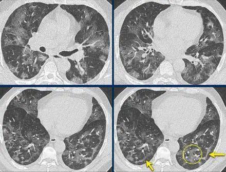 新型肺炎实时通报与探索自然美景的心灵之旅