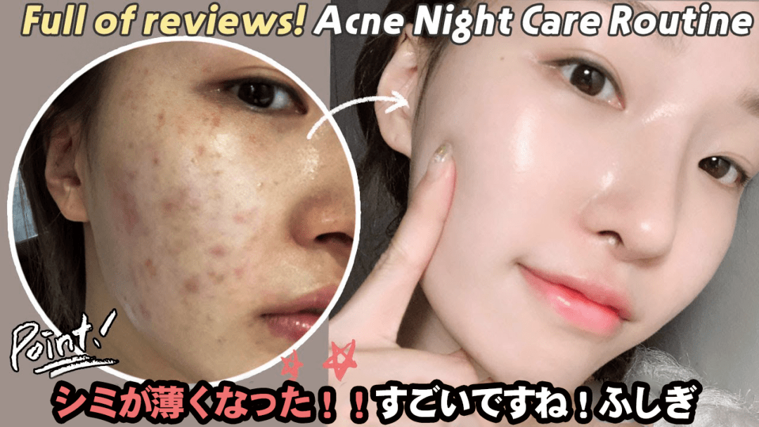 祛痣最新技术,重塑肌肤之美,无痕祛痣新选择